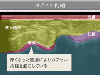 カプセル拘縮