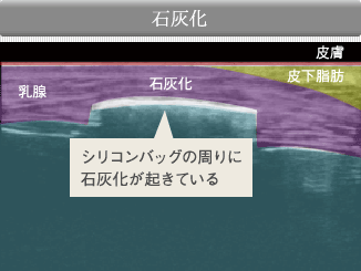 石灰化