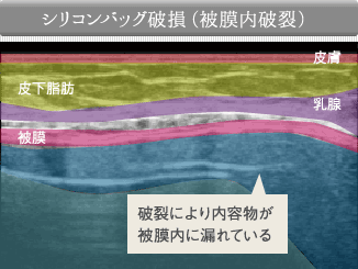 シリコンバッグ破損（被膜内破裂）