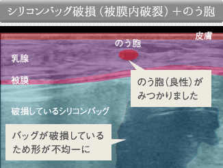 シリコンバッグ破損（被膜内破裂）＋のう胞