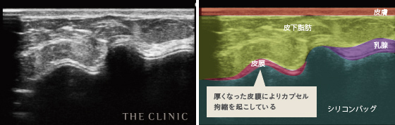 厚くなった皮膜によりカプセル拘縮を起こしている