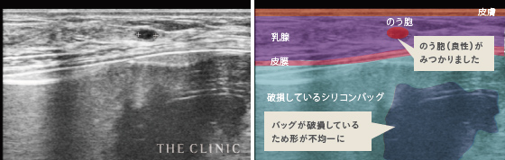 バッグが破損しているためが不均一に／のう胞（良性）がみつかりました