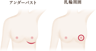 一般的切開部位は、アンダーバストまたは乳輪周囲です