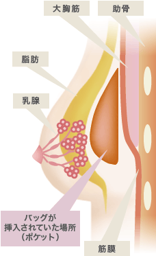 摘出（抜去）の際に周辺組織を傷つけてしまうと、バッグが挿入されていた場所（ポケット）が綺麗に保たれた状態にならず、再生豊胸の施術を行っても本来の効果が得られなくなってしまいます