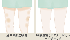 ベイザーリポを使用した場合、採取部位がデコボコになることはありません。