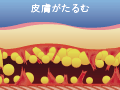 内出血や知覚鈍磨などを引き起こしやすく、ダウンタイムも長く、辛い術後が続きます。