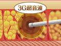 振動のエネルギーの３G（第３世代）超音波（VASER波）で治療部位の脂肪だけを遊離させます。