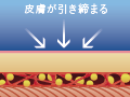 皮膚を引き締めながら、皮下脂肪の90%の採取が可能です。