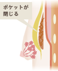 ポケットが閉じる