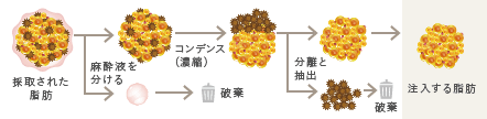 吸引された脂肪から麻酔液を分け、濃縮し、老化細胞を破棄し、健全な脂肪のみ注入します