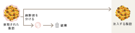 吸引された脂肪から麻酔液を分け、注入します