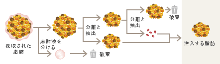 吸引された脂肪から麻酔液を分け、幹細胞を抽出し、注入します