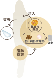 シリコンバッグを摘出し、自己脂肪を採取した後、健全な脂肪のみを取り出し、注入します。