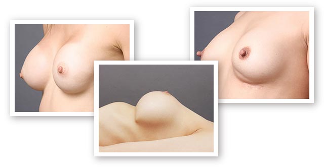 不自然なバストライン、リップリング、バストの段差