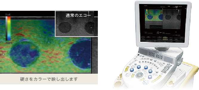 硬さや血流も視覚化する乳腺用エコー