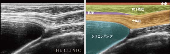 正常な状態のシリコンバッグ