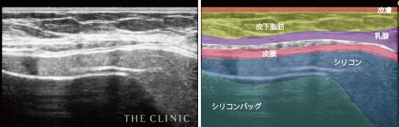 シリコンバッグ破損(皮膜内破損)