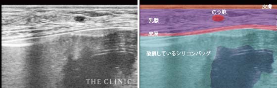 シリコンバッグ破損(皮膜内破裂)+のう胞
