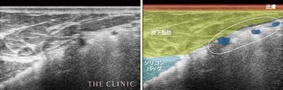 シリコンバッグ破損(皮膜外破損)