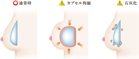 皮膜・石灰化の状態