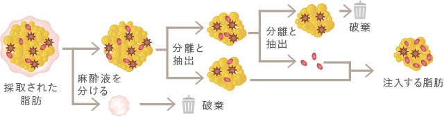 脂肪幹細胞注入