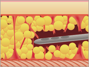 カニューレで脂肪を掻きだすように採取します。