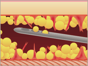 血管や神経が集まる筋肉層や、皮膚と筋肉をつなぐ繊維組織にダメージを与えながら採取します。