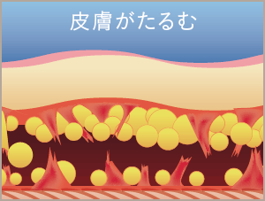 内出血や知覚鈍磨などを引き起こしやすく、ダウンタイムも長く、辛い術後が続きます。