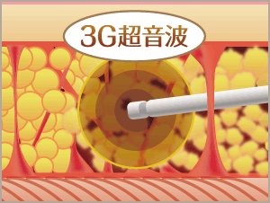 振動のエネルギーの3G(第3世代)超音波(VASER波)で治療部位の脂肪だけを遊離させます。