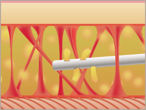刃のないカニューレで採取します。