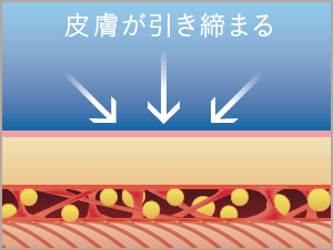 皮膚を引き締めながら、皮下脂肪の90%の採取が可能です。