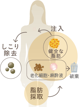 脂肪採取→注入→しこり除去