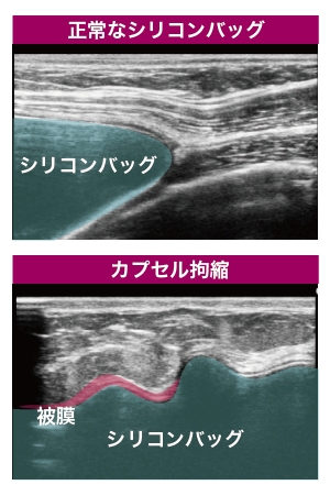 豊胸 シリコンバッグ エコー画像