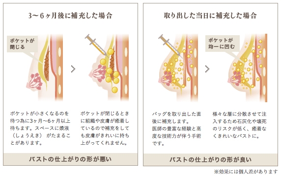 シリコンバッグ抜去 脂肪注入 当日