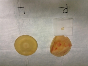豊胸手術 シリコンバッグ 破損