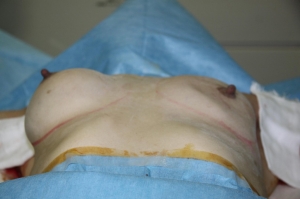 豊胸手術 バッグ抜去 画像