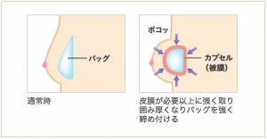 シリコンバッグ カプセル拘縮