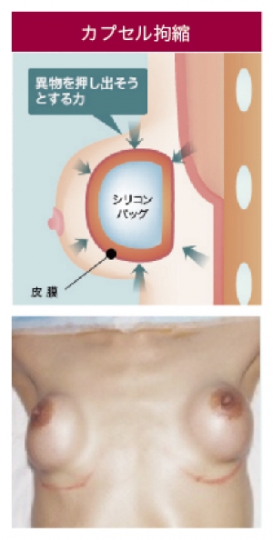 カプセル拘縮 画像