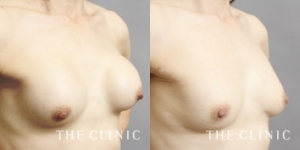 カプセル拘縮 治療 画像