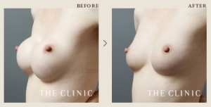 バッグ抜去 豊胸手術 症例