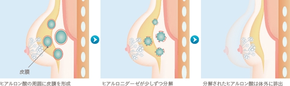 ヒアルロン酸豊胸 効果