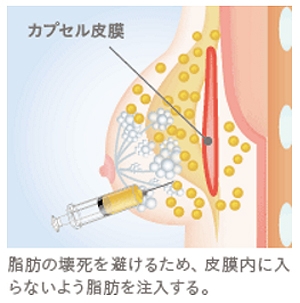 シリコンバッグ抜去 脂肪豊胸
