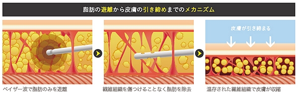 ベイザー脂肪吸引 違い