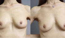痩せ型でも脂肪注入豊胸はできる？シリコンバッグ豊胸からの卒業【前編】 イメージ画像