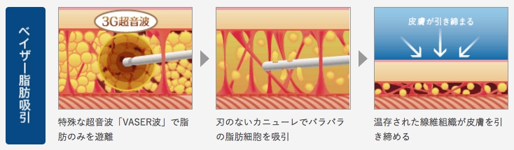豊胸手術 脂肪吸引