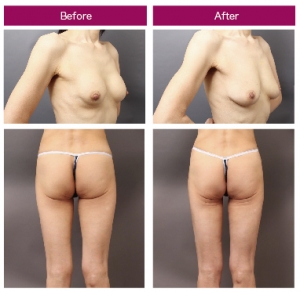 生理食塩水バッグ 脂肪豊胸 脂肪吸引