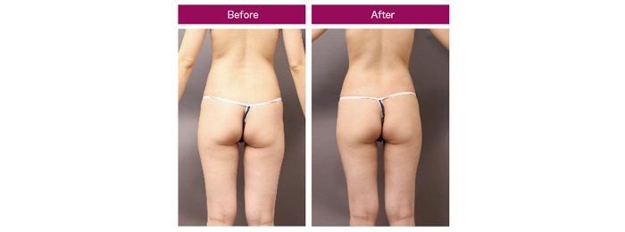 脂肪豊胸 痩せ型 脂肪吸引