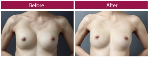 脂肪豊胸 痩せ型 症例画像