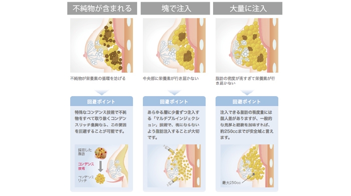 脂肪注入 しこり 原因