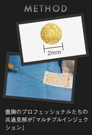 脂肪注入 しこり 技術